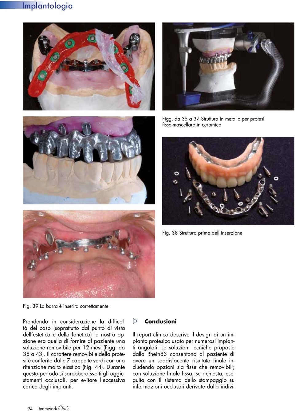 paziente una soluzione removibile per 12 mesi (Figg. da 38 a 43). Il carattere removibile della protesi è conferito dalle 7 cappette verdi con una ritenzione molto elastica (Fig. 44).