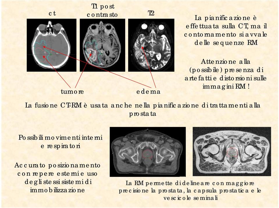 La fusione CT-RM è usata anche nella pianificazione di trattamenti alla prostata Possibili movimenti interni e respiratori Accurato