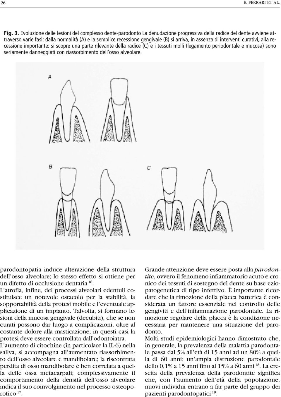 arriva, in assenza di interventi curativi, alla recessione importante: si scopre una parte rilevante della radice (C) e i tessuti molli (legamento periodontale e mucosa) sono seriamente danneggiati