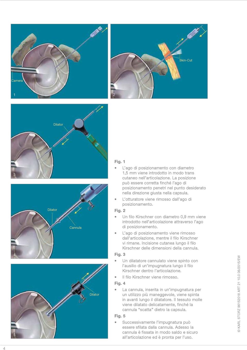 4 5 Dilator Cannula Dilator Fig. 2 Un filo Kirschner con diametro 0,9 mm viene introdotto nell articolazione attraverso l ago di posizionamento.