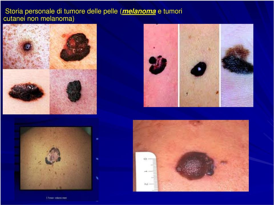 (melanoma e tumori