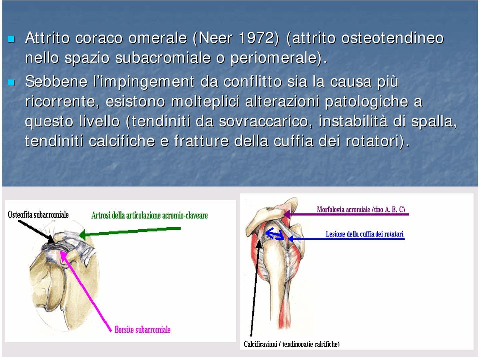 Sebbene l impingementl da conflitto sia la causa più ricorrente, esistono molteplici