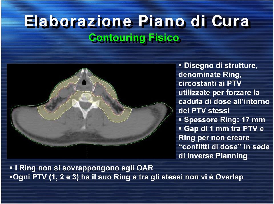 Gap di mm tra PTV e Ring per non creare conflitti di dose in sede di Inverse Planning I Ring