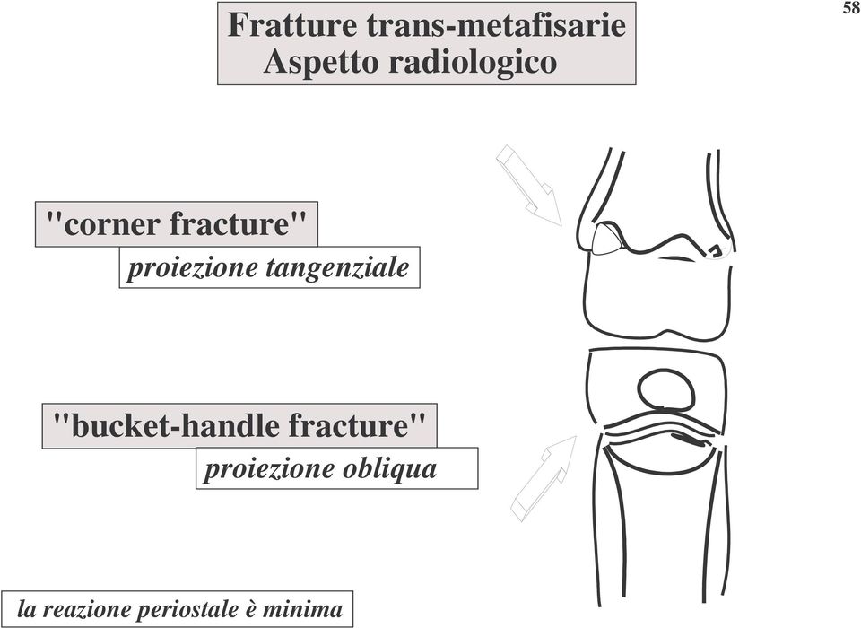 proiezione tangenziale "bucket-handle