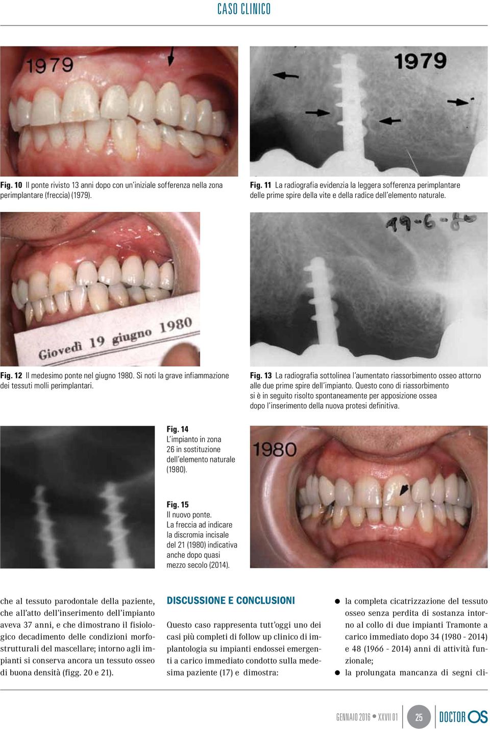 Si noti la grave infiammazione dei tessuti molli perimplantari. Fig. 13 La radiografia sottolinea l aumentato riassorbimento osseo attorno alle due prime spire dell impianto.