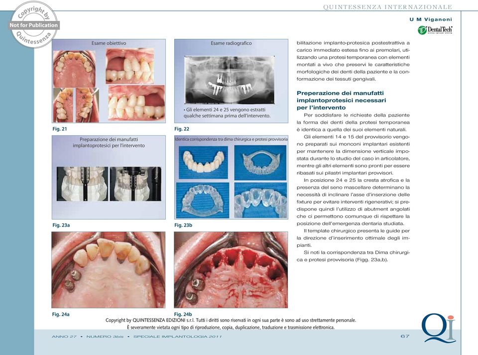 23a Preparazione dei manufatti implantoprotesici per l intervento Gli elementi 24 e 25 vengono estratti qualche settimana prima dell intervento.