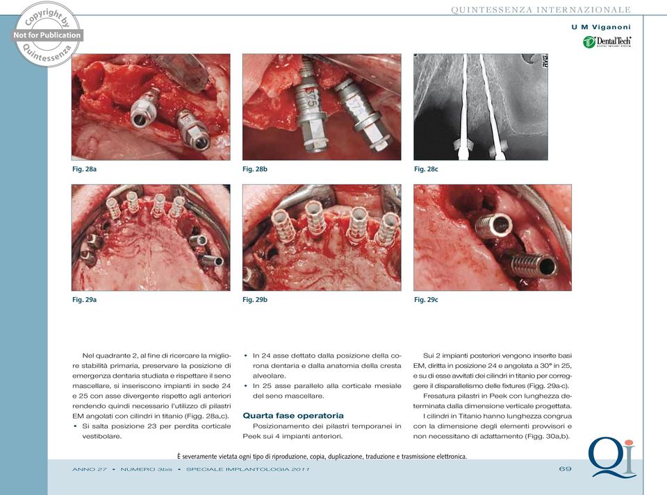 25 con asse divergente rispetto agli anteriori rendendo quindi necessario l utilizzo di pilastri EM angolati con cilindri in titanio (Figg. 28a,c).