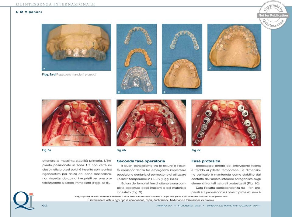 Seconda fase operatoria Il buon parallelismo tra le fixture e l esatta corrispondenza tra emergenza implantare eposizione dentaria ci permettono di utilizzare i pilastri temporanei in PEEK (Figg.