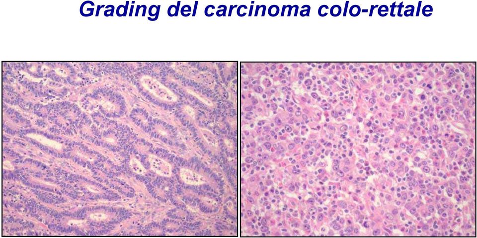 carcinoma