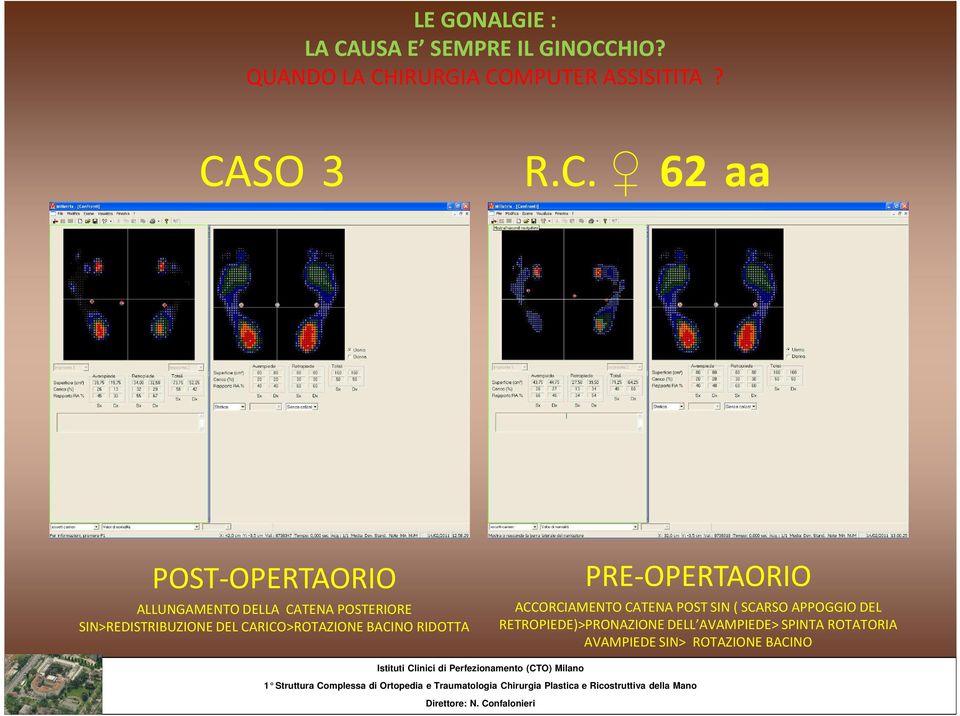 ACCORCIAMENTO CATENA POST SIN ( SCARSO APPOGGIO DEL