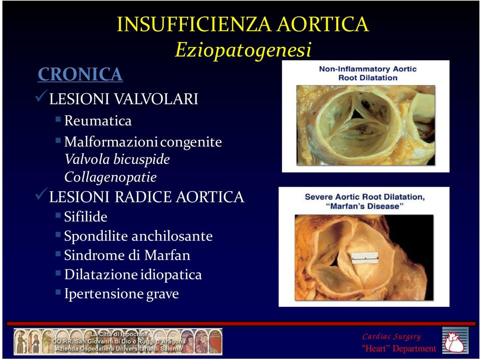 Collagenopatie LESIONI RADICE AORTICA Sifilide Spondilite