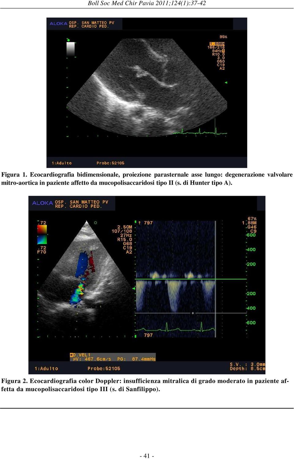 mitro-aortica in paziente affetto da mucopolisaccaridosi tipo II (s. di Hunter tipo A). Figura 2.