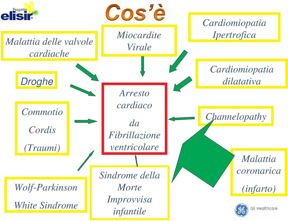 Fibrillazione ventricolare Sindrome della Morte Improvvisa infantile