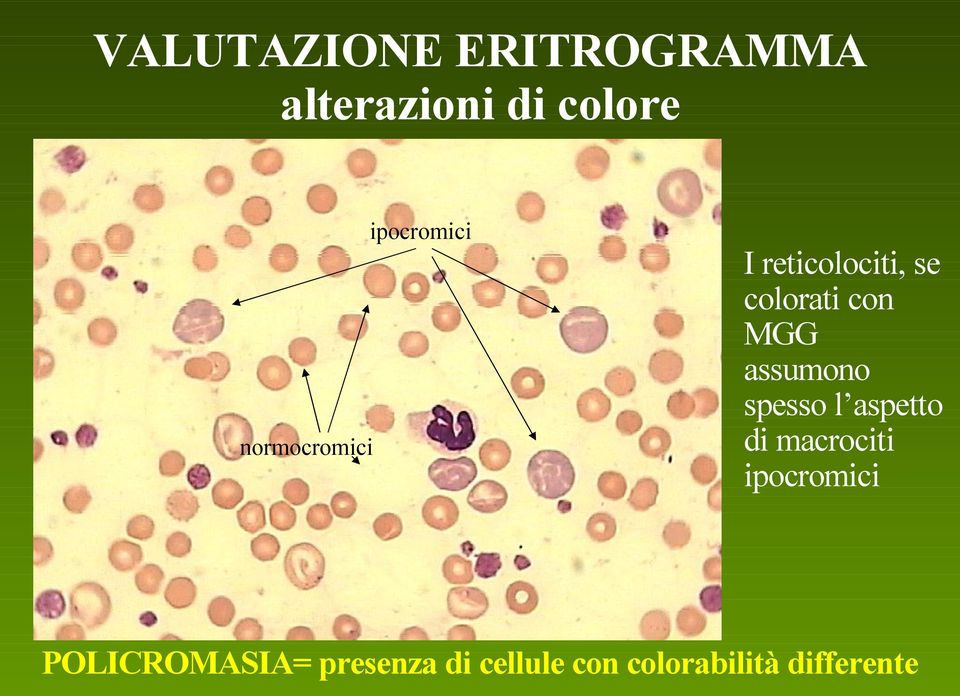 con MGG assumono spesso l aspetto di macrociti