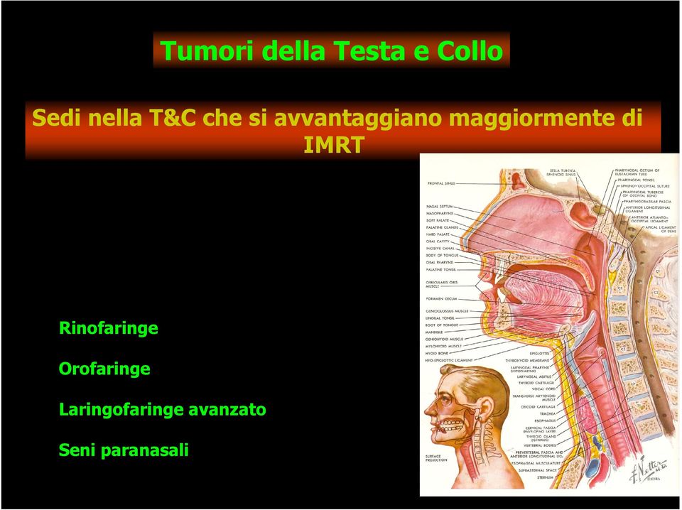 maggiormente di IMRT Rinofaringe