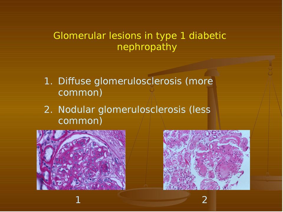 Diffuse glomerulosclerosis (more