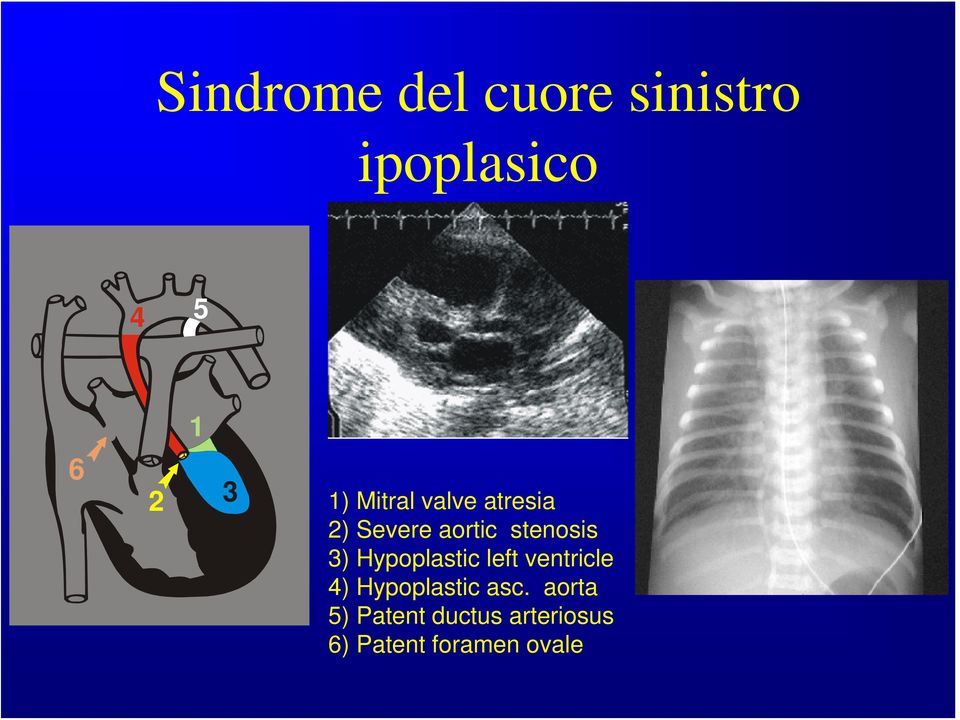 3) Hypoplastic left ventricle 4) Hypoplastic asc.