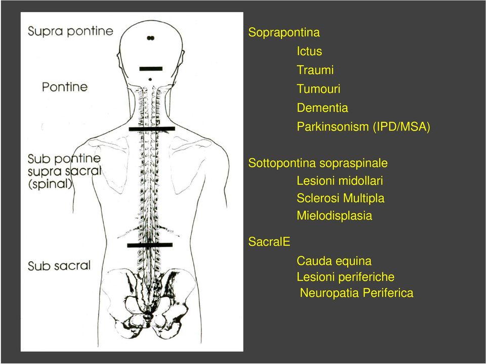 SacralE Lesioni midollari Sclerosi Multipla