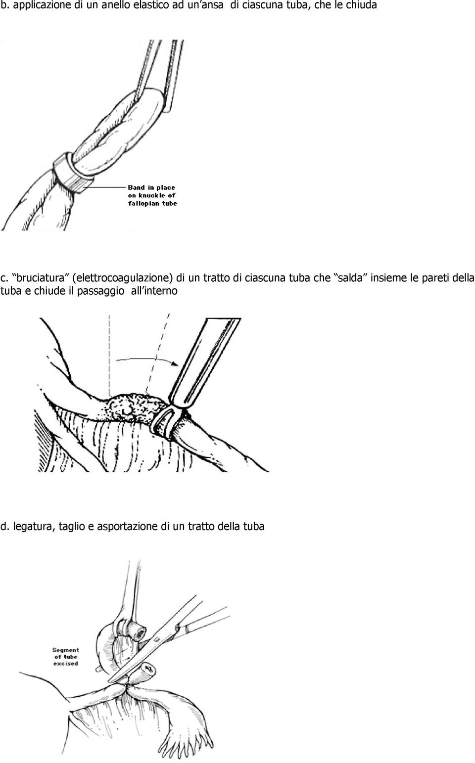 bruciatura (elettrocoagulazione) di un tratto di ciascuna tuba che