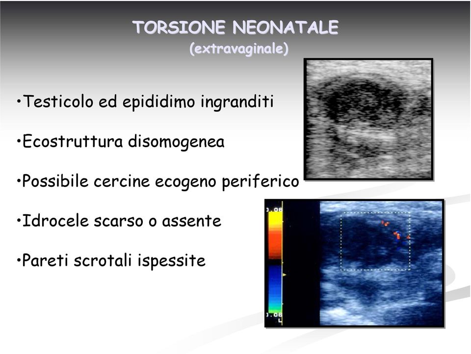 disomogenea Possibile cercine ecogeno