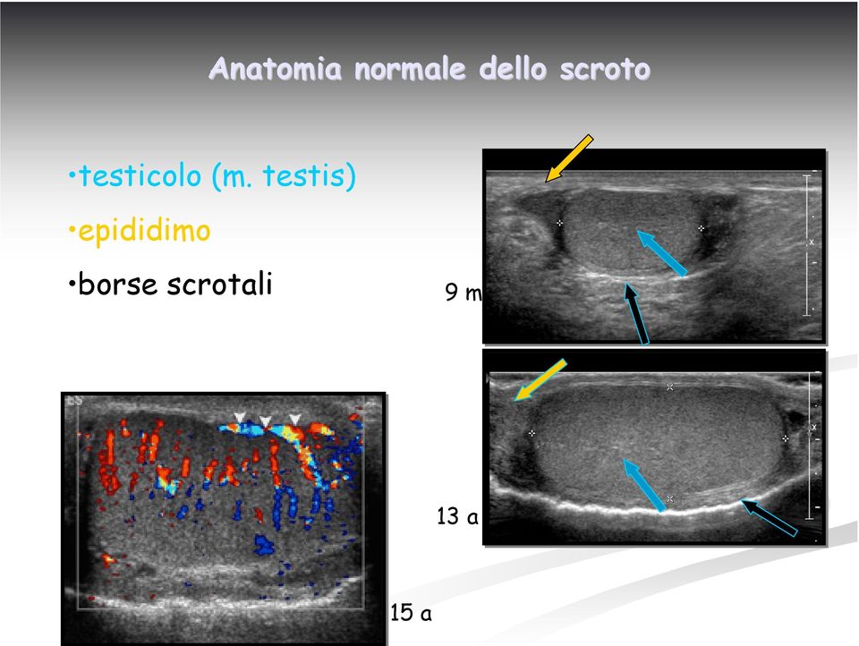 testis) epididimo