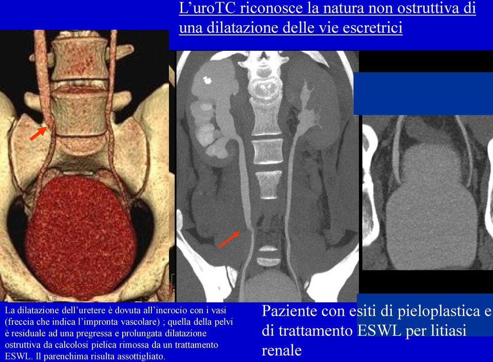 residuale ad una pregressa e prolungata dilatazione ostruttiva da calcolosi pielica rimossa da un trattamento