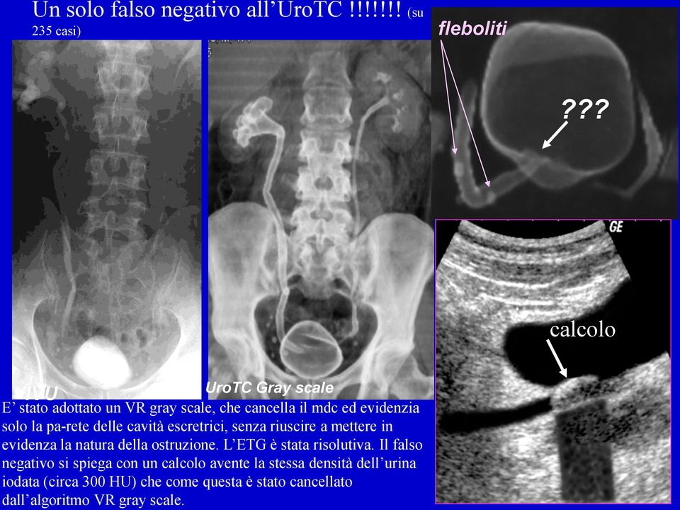 delle cavità escretrici, senza riuscire a mettere in evidenza la natura della ostruzione. L ETG è stata risolutiva.