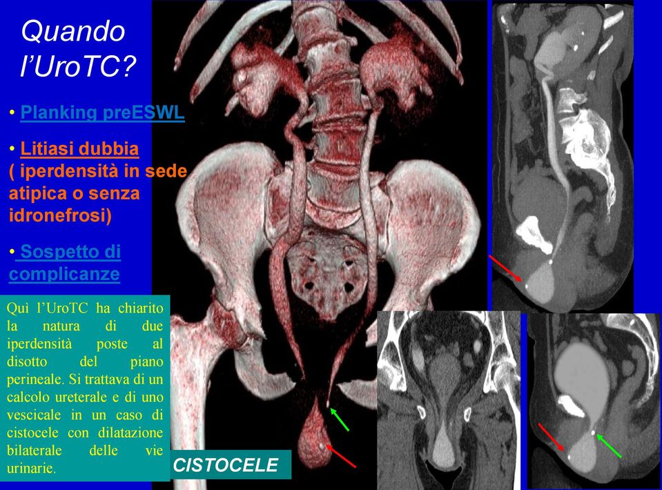complicanze Solo l UroTC ha natura di idronefrosi Quì l UroTC ha chiarito la due iperdensità poste