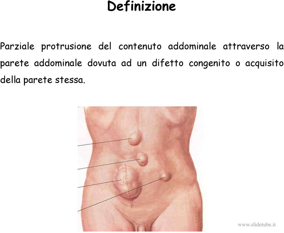 parete addominale dovuta ad un difetto