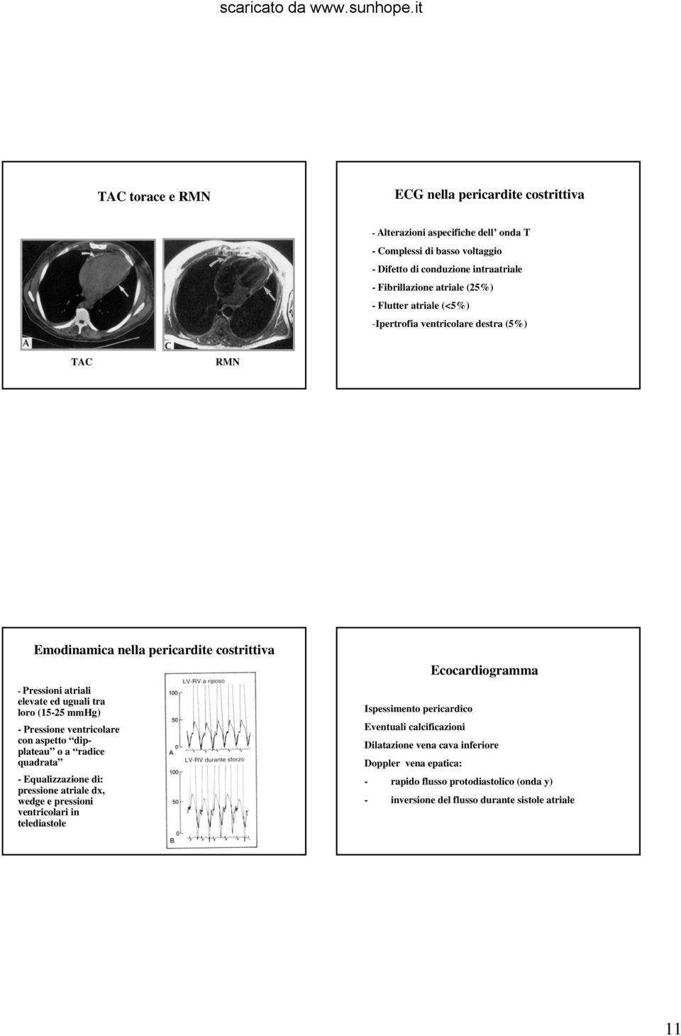 Pressione ventricolare con aspetto dipplateau o a radice quadrata - Equalizzazione di: pressione atriale dx, wedge e pressioni ventricolari in telediastole Ecocardiogramma