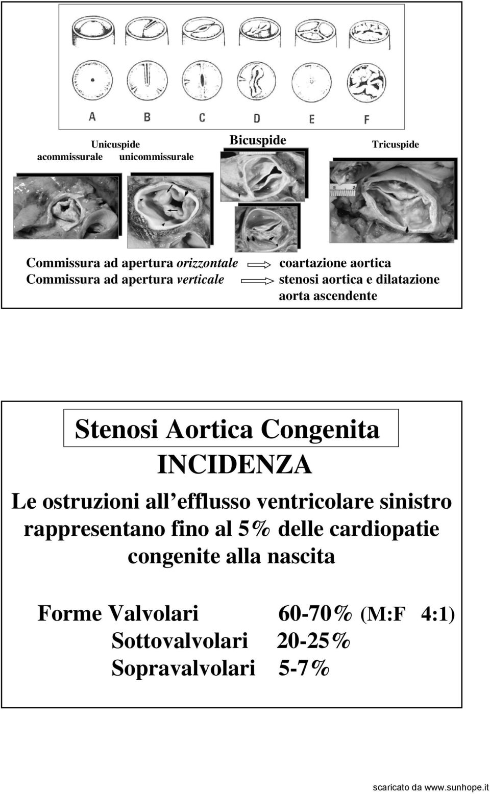 Stenosi Aortica Congenita INCIDENZA Le ostruzioni all efflusso ventricolare sinistro rappresentano fino