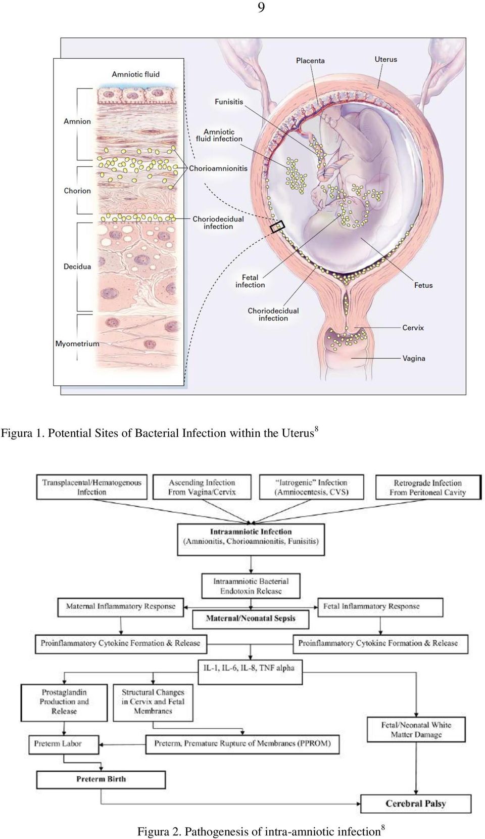 Infection within the Uterus 8