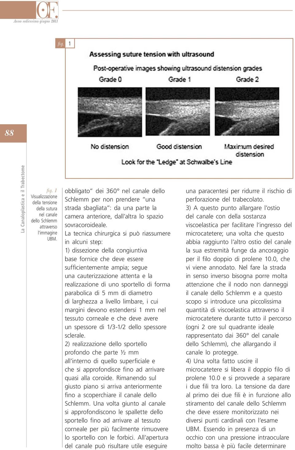 La tecnica chirurgica si può riassumere in alcuni step: 1) dissezione della congiuntiva base fornice che deve essere sufficientemente ampia; segue una cauterizzazione attenta e la realizzazione di