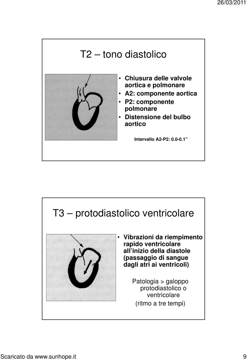 1 T3 protodiastolico ventricolare Vibrazioni da riempimento rapido ventricolare all inizio della diastole