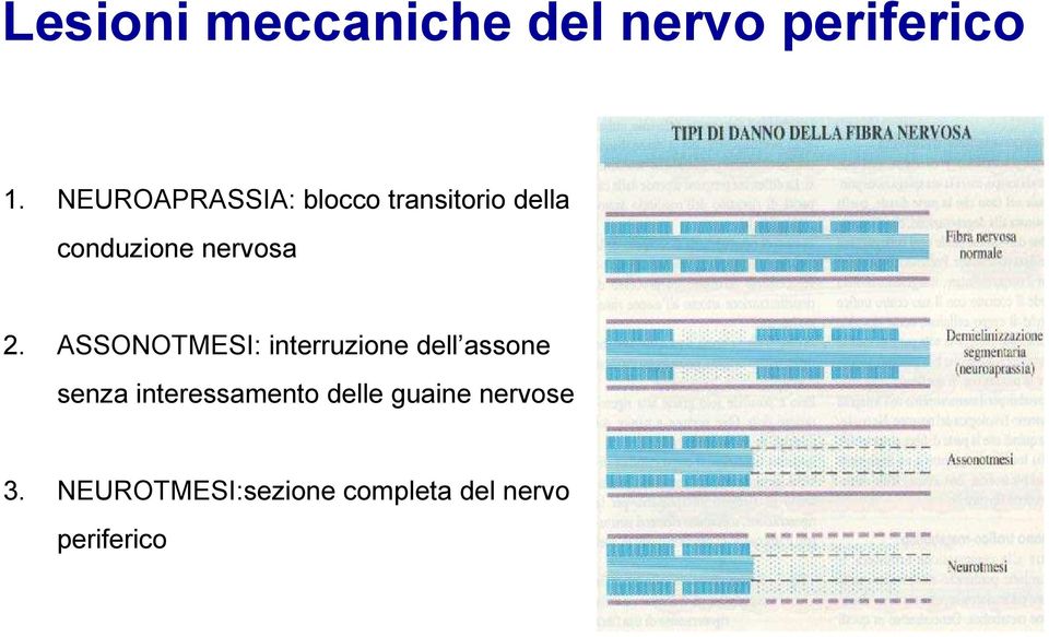 2. ASSONOTMESI: interruzione dell assone senza