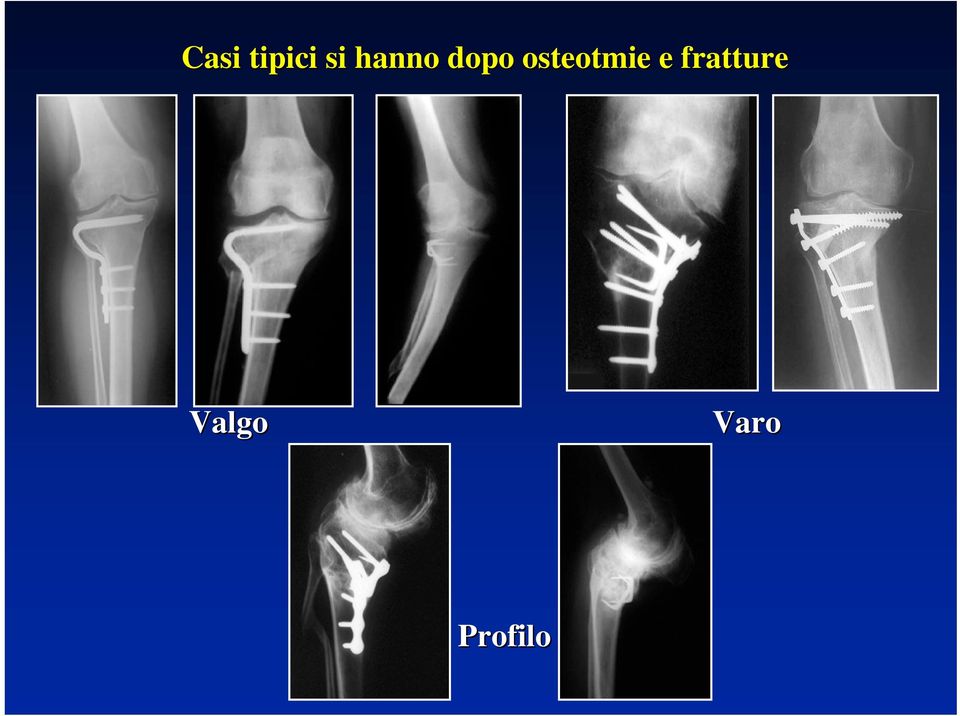 osteotmie e