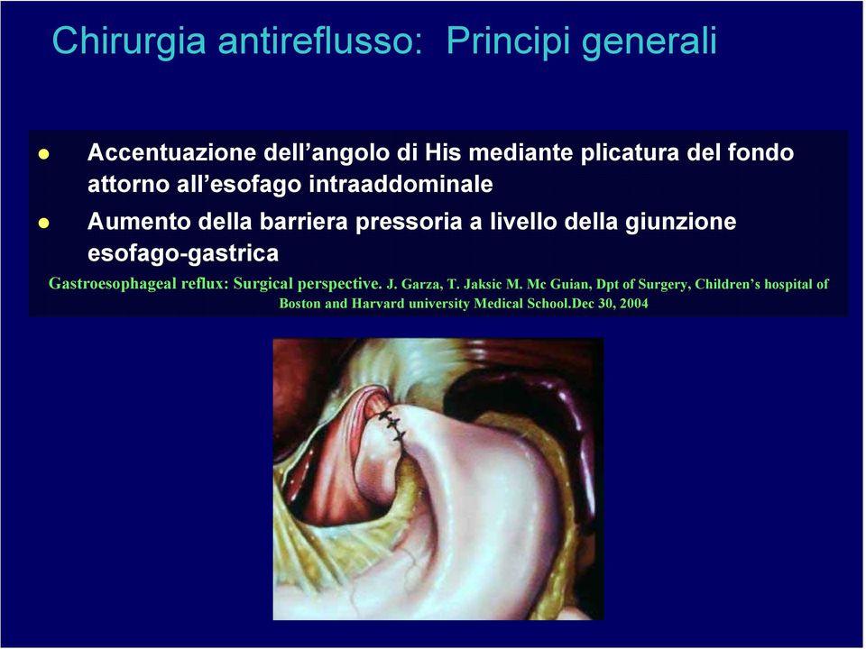 giunzione esofago-gastrica Gastroesophageal reflux: Surgical perspective. J. Garza, T. Jaksic M.