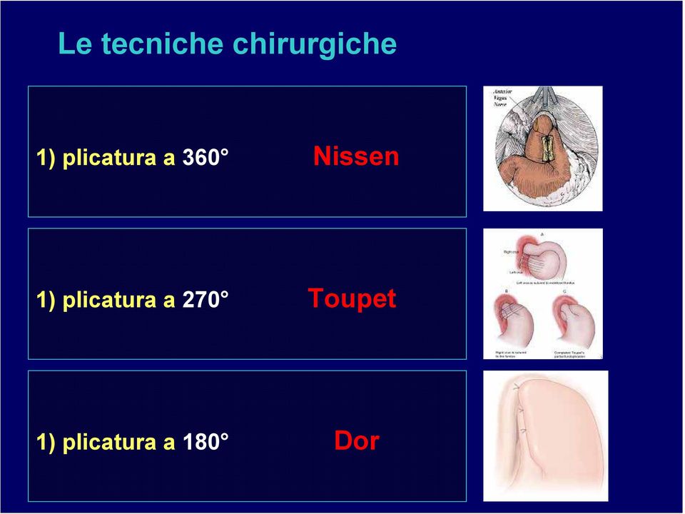 Nissen 1) plicatura a