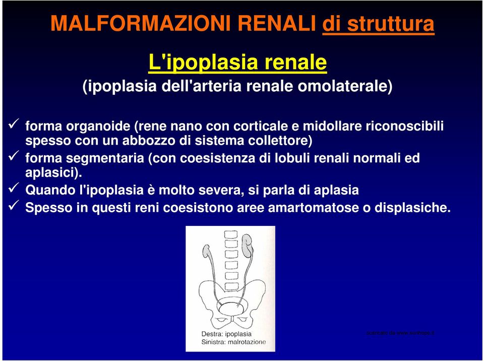 collettore) forma segmentaria (con coesistenza di lobuli renali normali ed aplasici).