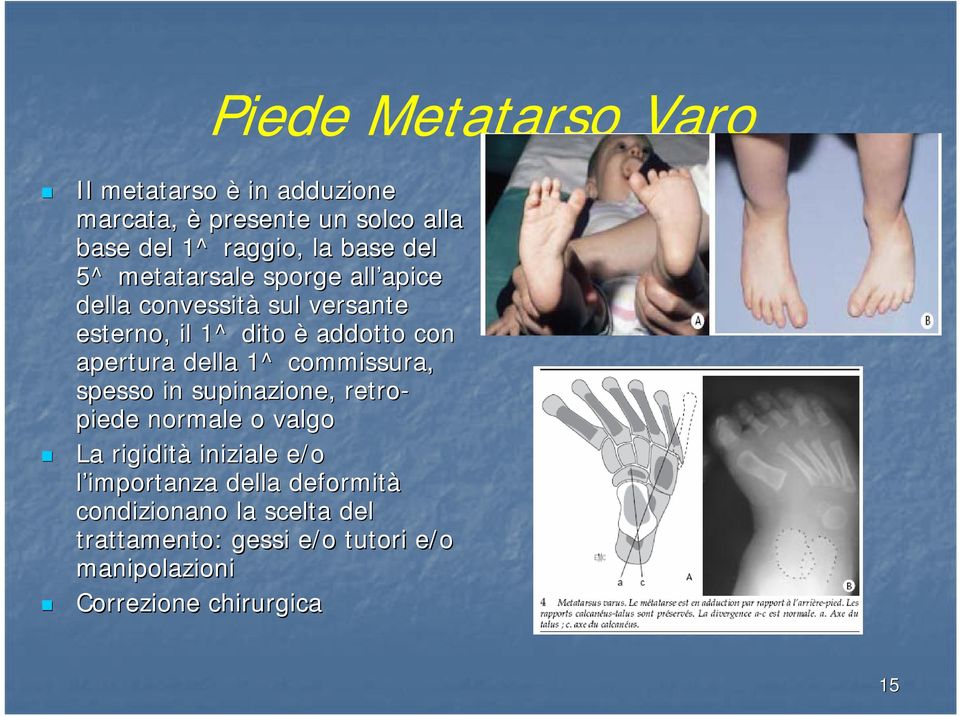 apertura della 1^ commissura, spesso in supinazione, retro- piede normale o valgo La rigidità iniziale e/o l