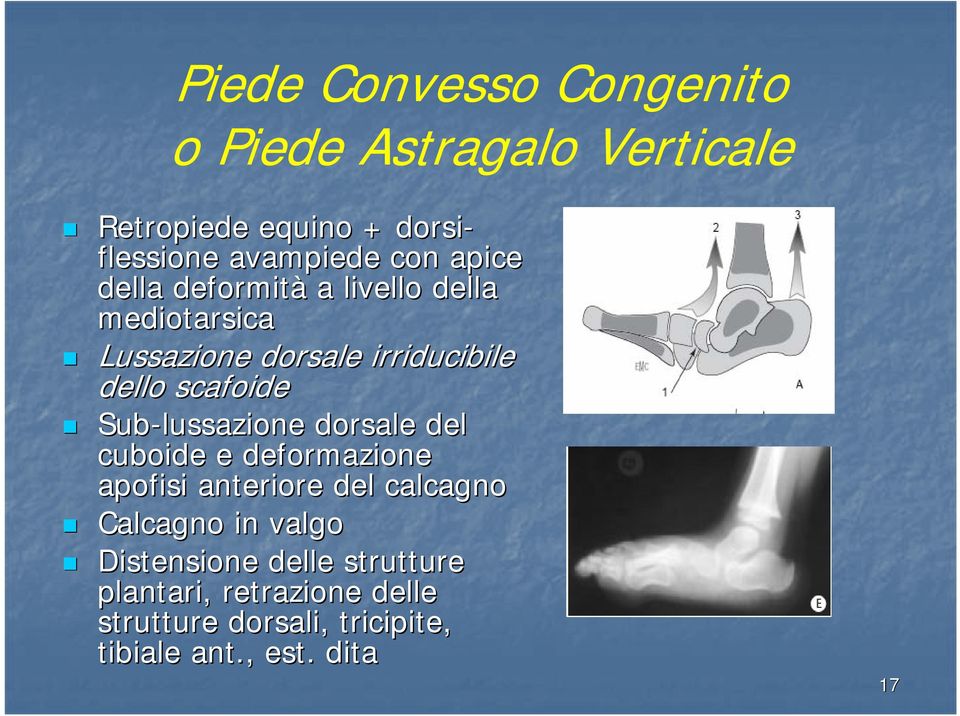 Sub-lussazione dorsale del cuboide e deformazione apofisi anteriore del calcagno Calcagno in valgo