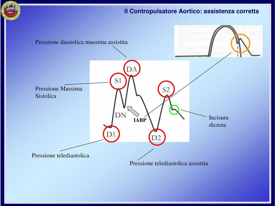 Massima Sistolica IABP Incisura dicrota