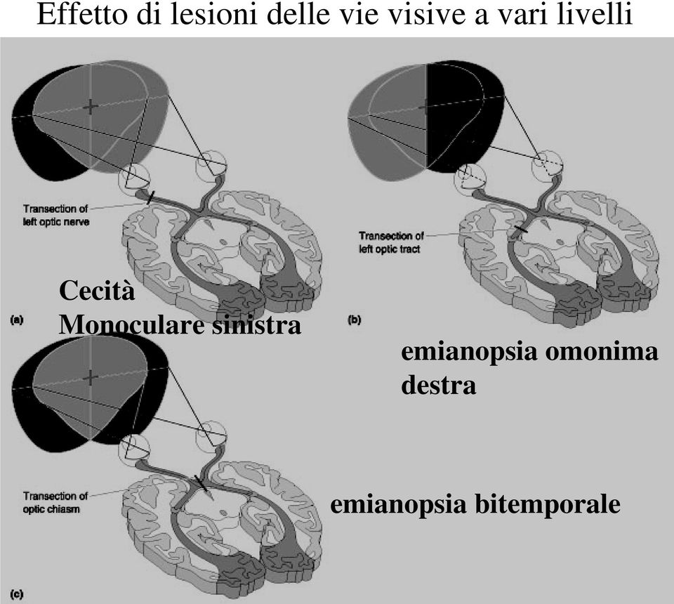 Monoculare sinistra emianopsia