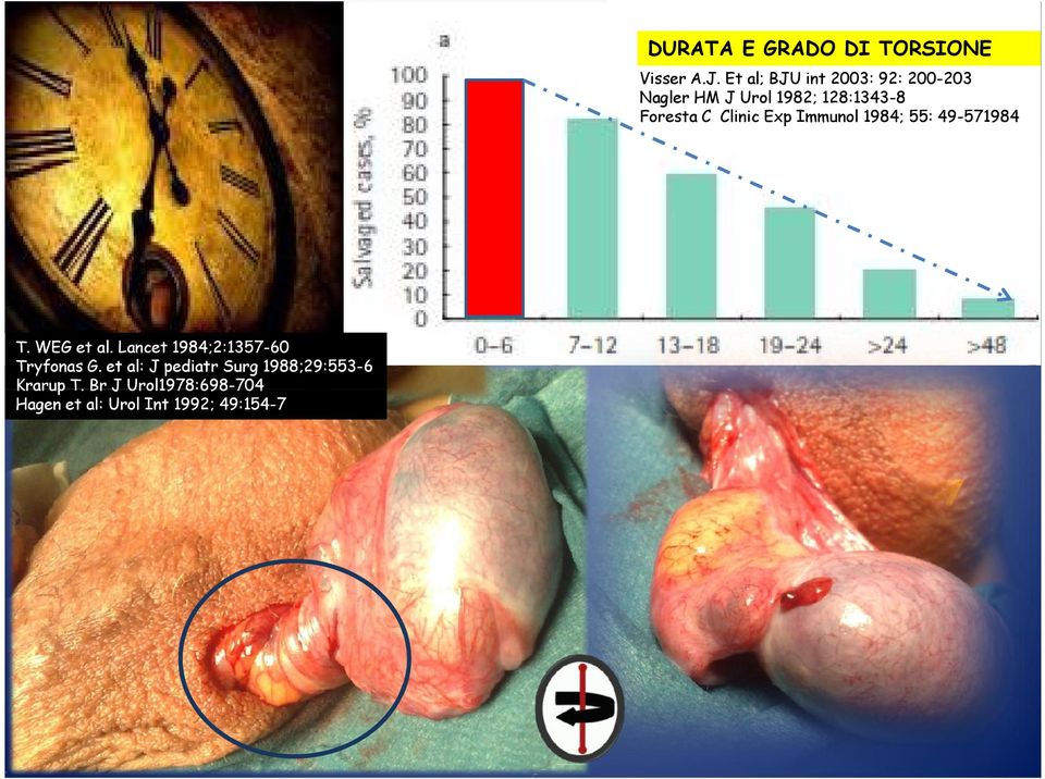 Br J Urol1978:698-704 Hagen et al: Urol Int 1992; 49:154-7 DURATA E GRADO DI TORSIONE Visser