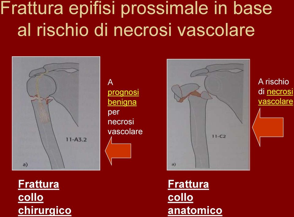 necrosi vascolare A rischio di necrosi