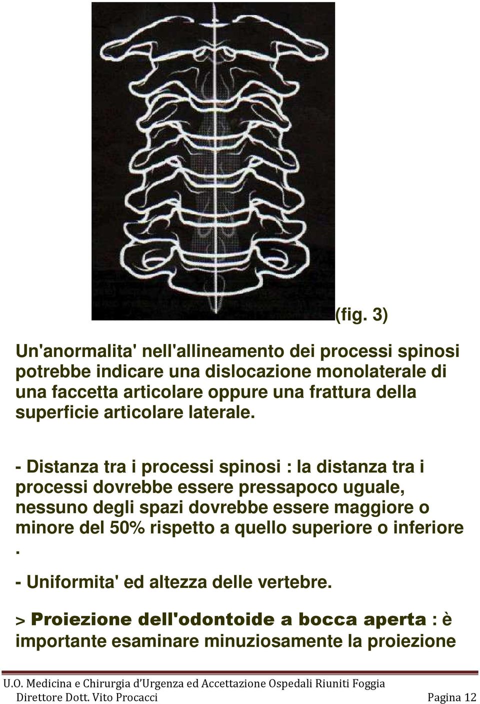 - Distanza tra i processi spinosi : la distanza tra i processi dovrebbe essere pressapoco uguale, nessuno degli spazi dovrebbe essere maggiore