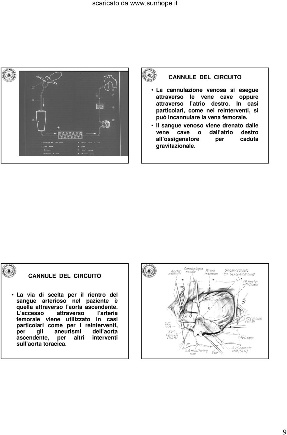 Il sangue venoso viene drenato dalle vene cave o dall atrio destro all ossigenatore per caduta gravitazionale.