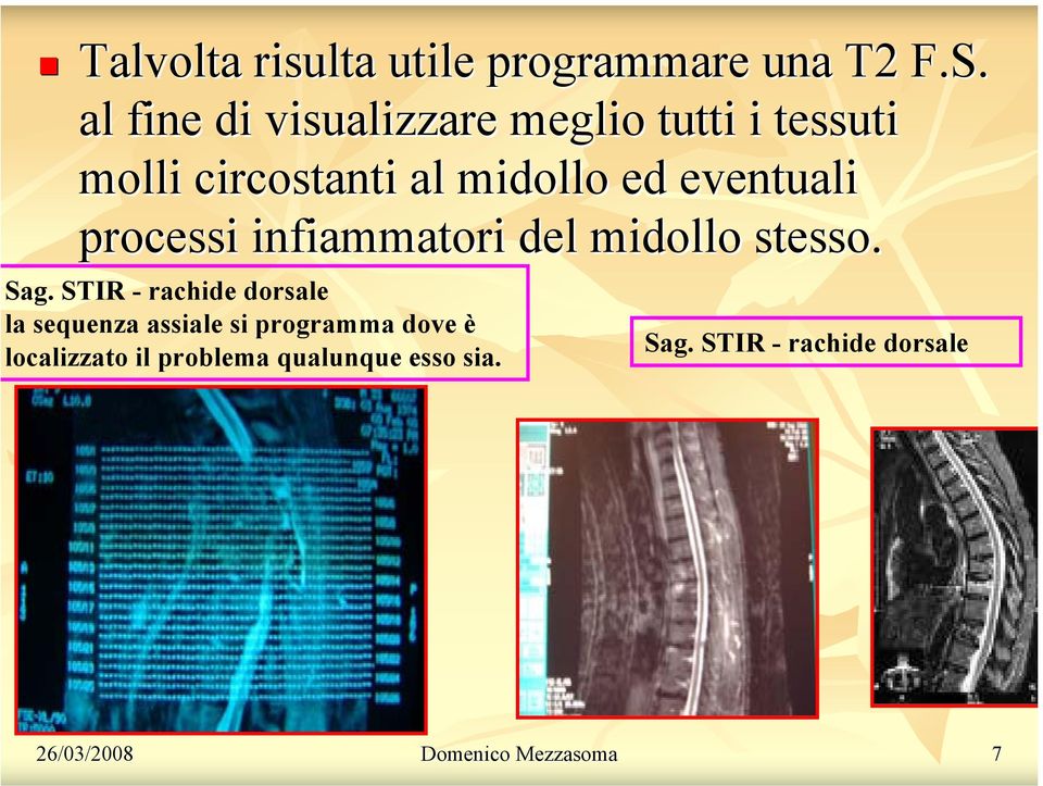 eventuali processi infiammatori del midollo stesso. Sag.