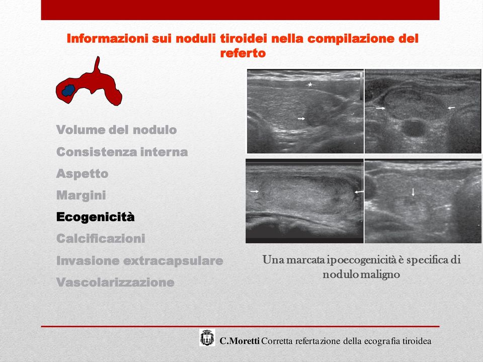 Margini Ecogenicità Calcificazioni Invasione extracapsulare