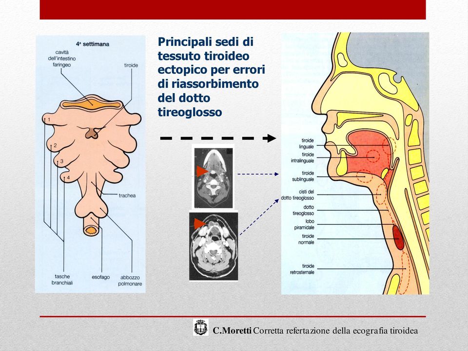 ectopico per errori di